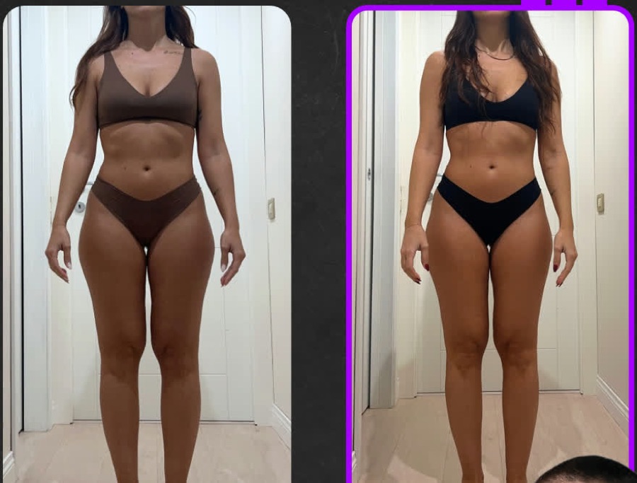 Prima e dopo: 8 settimane di nutrizione e coaching: disbiosi fermentativa risolta, sintomi dell'IBS ridotti, culotte de cheval e accumuli ridotti.