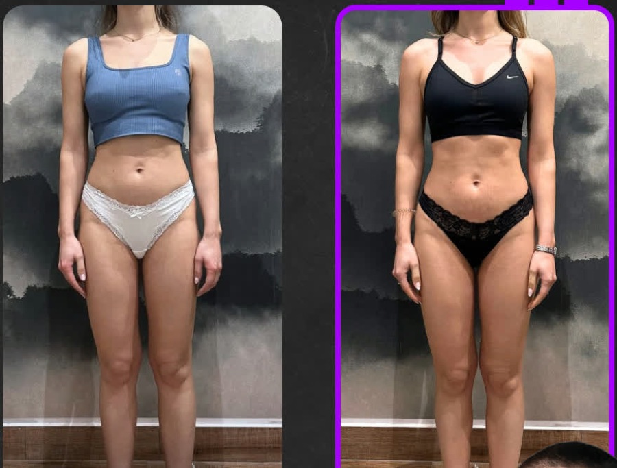 Prima e dopo: 4 settimane di percorso nutrizionale: disbiosi fermentativa risolta, gonfiori cronici risolti e muscolo aumentato.