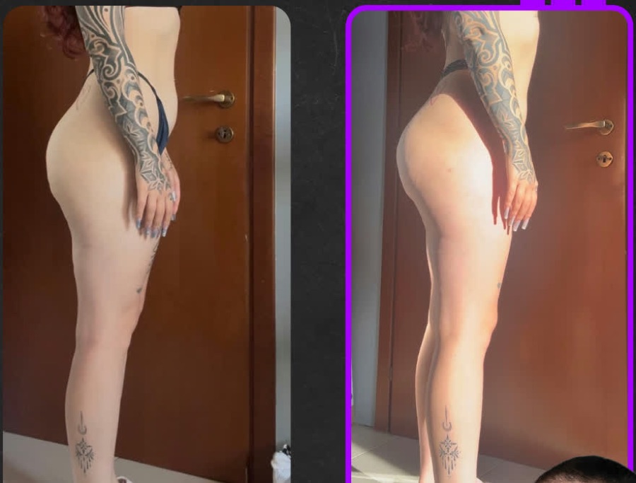 Prima e dopo: Alvo regolarizzato, glutei aumentati di svariati centimetri.