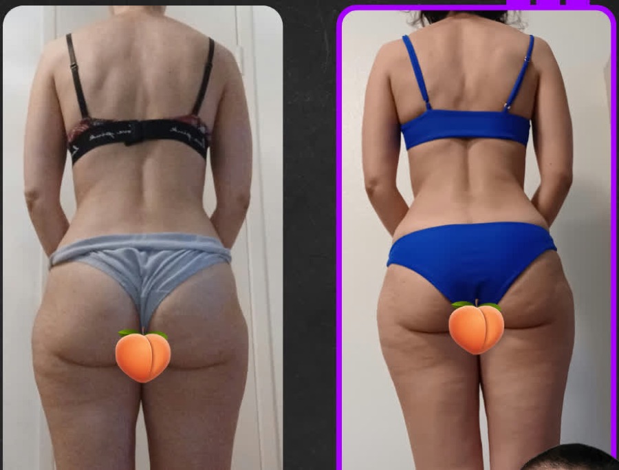 Prima e dopo: 12 settimane: disbiosi putrefattiva risolta, glutei e gambe che iniziano a rispondere.